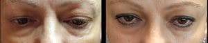 Strawberry Eye Lift effectively targets various concerns, including: • Fine lines and wrinkles. • Dark circles. • Puffiness. • Uneven skin tone. • Sagging eyelids. • Crow’s feet. • Crepey skin. This personalised treatment approach ensures that each concern is addressed, leading to a more youthful and vibrant appearance. By focusing on your unique needs, we enhance the delicate eye area, providing a comprehensive solution that not only improves aesthetics but also promotes long-term skin health.